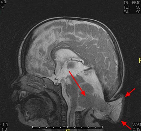 Chiari Malformation - Causes, Symptoms, Prognosis, Diagnosis, Treatment