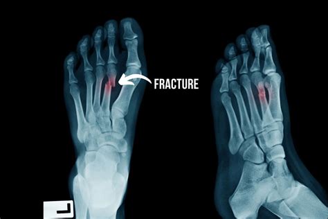 Everything You Need to Know About Foot Fractures - Straits Podiatry