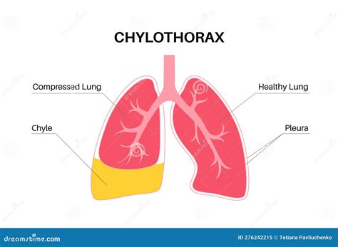 Chylothorax Anatomical Poster Stock Vector - Illustration of lung, lymphatic: 276242215