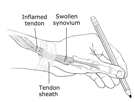 Tendinitis Of Wrist