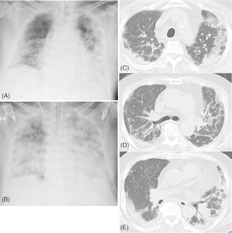 Hospital X-ray Chest 的图像结果