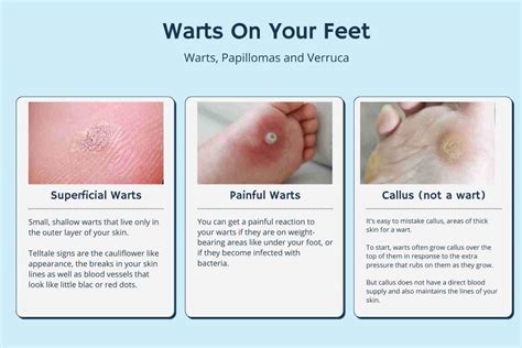 How To Treat Your Plantar Wart | 3 Podiatrist Approved Options