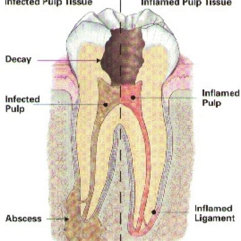 Extracting Abscessed Tooth 的图像结果