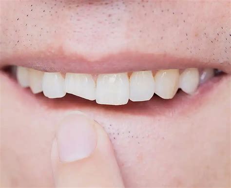 Image result for Broken Tooth