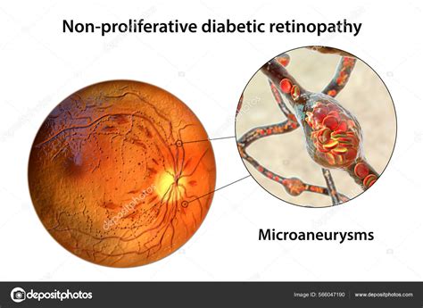 Non Proliferative Diabetic Retinopathy Illustration Showing Multiple ...