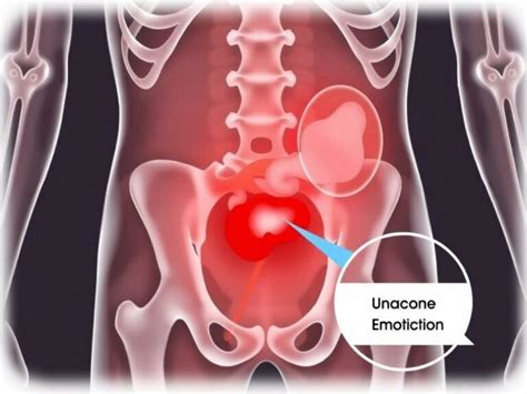Image result for Psoas Sign Appendicitis