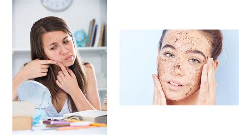 pastillas para el acne sin receta • Toallitas para el Acné: Guía de Compra