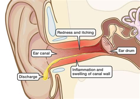 Relief For Itchy Inner Ear