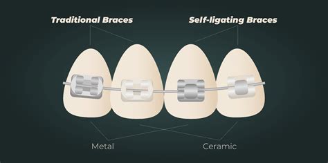 Dental Braces and Aligners: Types, Cost, Procedure and Benefits ...