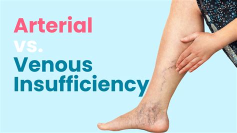 Arterial vs. Venous Insufficiency - Elite Vein Clinic