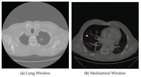 Optimal Thresholding for Multi-Window Computed Tomography (CT) to ...