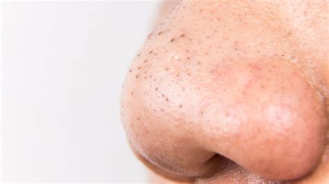 Blackhead On Face Inflamed Acne: Cystic Acne And Other Types, Plus How