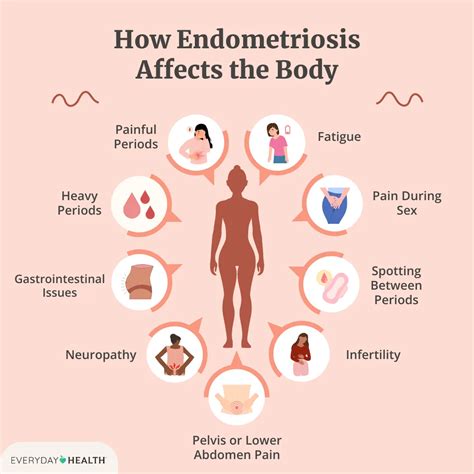 Endometriosis Pain Why Is Endometriosis Often Ignored? Symptoms And