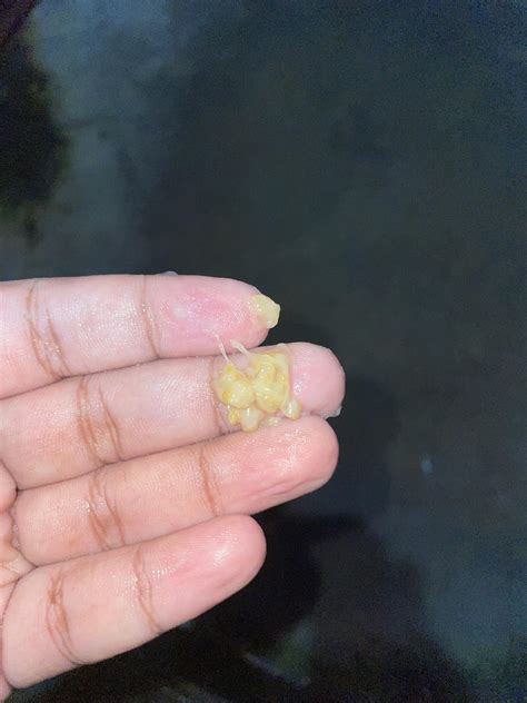 Why thick white mucus Coming out with my Poop??? I got Diarrhea 2 times in last 1 week.. those ...