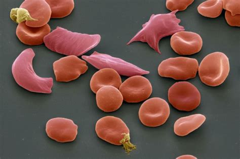 Initial Gene-Editing Trials Show Positive Results In Treating Blood ...