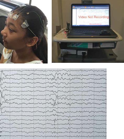 EEG Information – Dr Sekhar Cyril Pillai – Sydney Australia