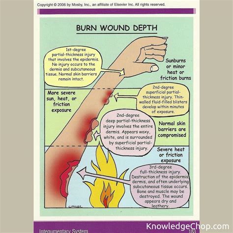 Burn Wound Depth | 🥷 Knowledge Ninja
