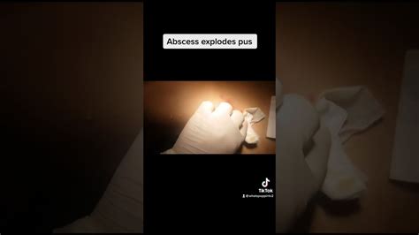 Image result for boils cysts abscesses exploding