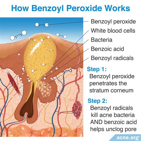 How Does Benzoyl Peroxide Work in the Skin? - Acne.org