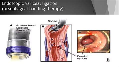 Esophageal varices and its management | PPTX