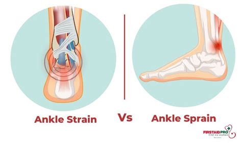 Sprain First Aid 的图像结果