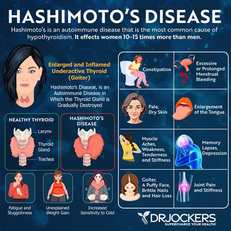 Specialist In Hashimoto's Thyroiditis