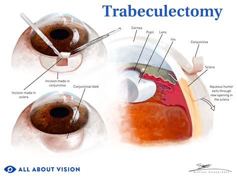 Surgery For Glaucoma