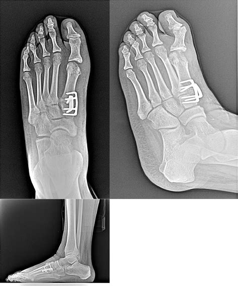 A novel construct for Lapidus bunionectomy utilizing nitinol staples - Foot & Ankle Surgery ...