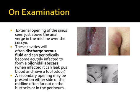 PILONIDAL SINUS2.pptx