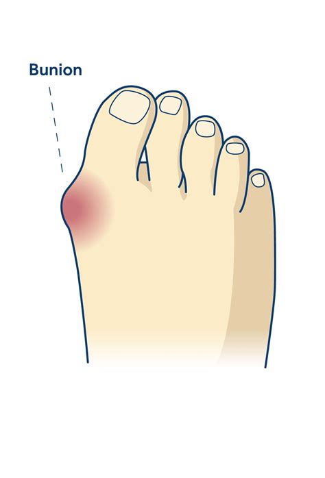 Bunions | Dapto Foot Clinic | Your Local Podiatrists