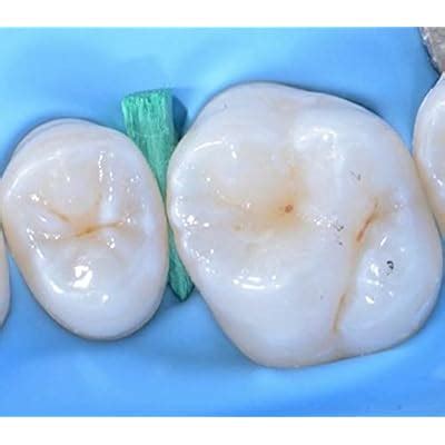 Wooden Wedges Dental, Teeth Interproximal Wedges India | Ubuy