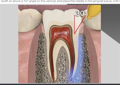 Surface Anesthesia 的图像结果