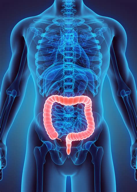 Colitis ulcerosa | Colitis ulcerativa | MedlinePlus en español