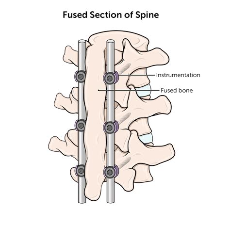 Spinal Fusion Surgery | Boston Children's Hospital