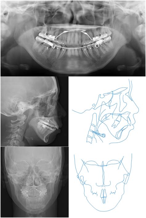 A case of anterior open bite associated with idiopathic condylar resorption treated with ...