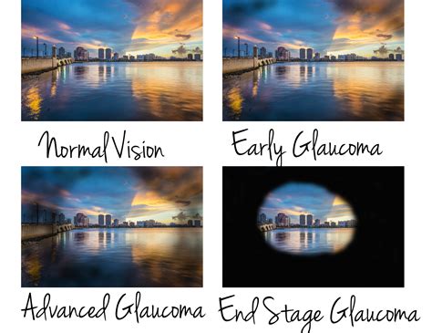Glaucoma Center – Eye Associates of Lancaster