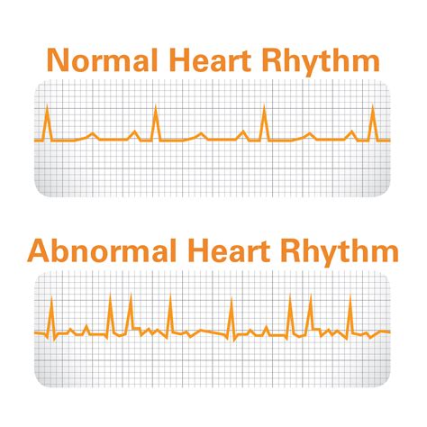 Atrial Fibrillation diagnosis | Get Smart About AFIB