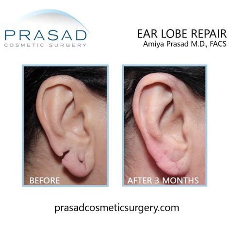Can Stretched or Torn Earlobes be Repaired? - Dr. Prasad Blog