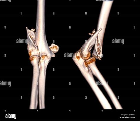 Computed Tomography Volume Rendering examination of elbow joint 3D rendering in patient fracture ...