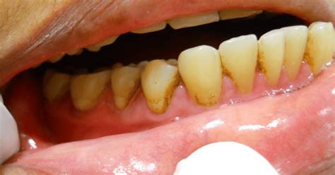 Image result for Discolored Tooth