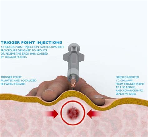 Trigger Point Injections 的图像结果