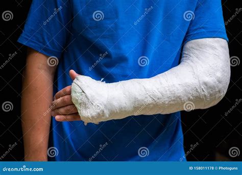 Man with Broken Arm Wrapped Medical Cast Plaster. Fiberglass Cast ...