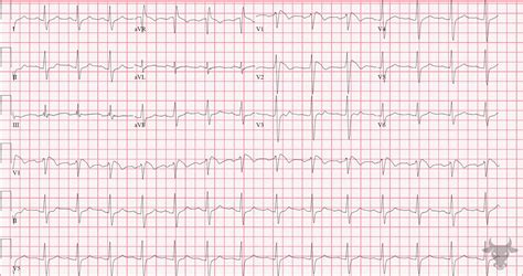 Brugada Syndrome | ECG Stampede
