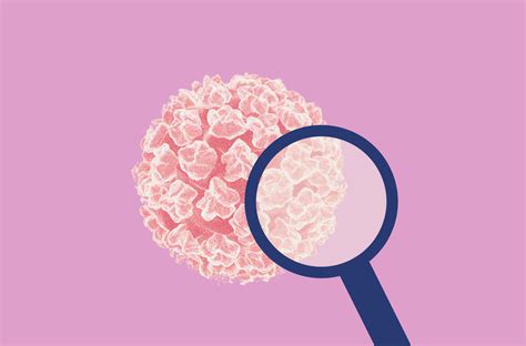 Sintomas De Cancer De Garganta Hpv Câncer De Orofaringe (garganta):