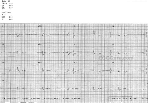 Junctional rhythm | ECG Guru - Instructor Resources
