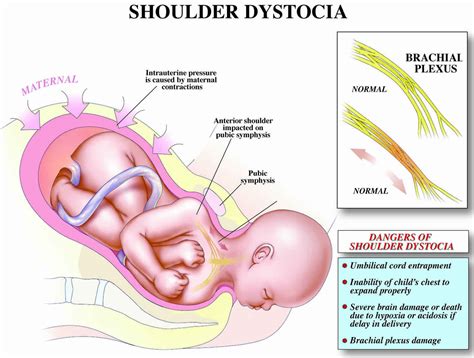 Shoulder dystocia, causes, signs, diagnosis, treatment, maneuvers ...
