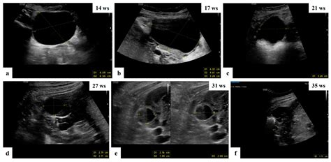 Ultrasound Pictures Of Ovarian Cysts Ovarian Adnexal Reporting And