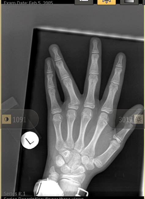 Leg Finger Dislocation at Tayla Sligo blog