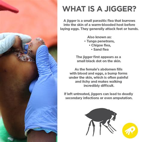 Image result for Jigger Bug Parasite