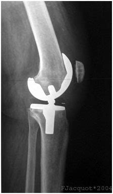 Joint Replacement in jalandhar :: joint replacement in joshi hospital ...